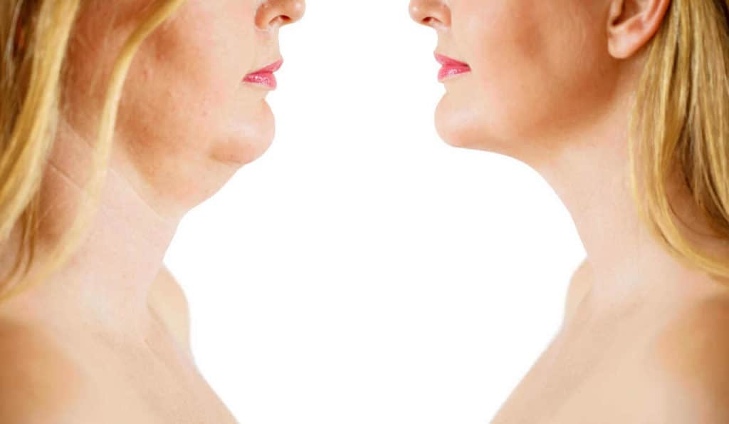 Double Chin treatment Bognor Regis before and after results
