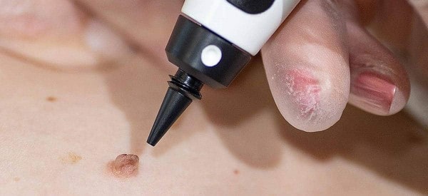 After Skin Tag Removal Bognor Regis