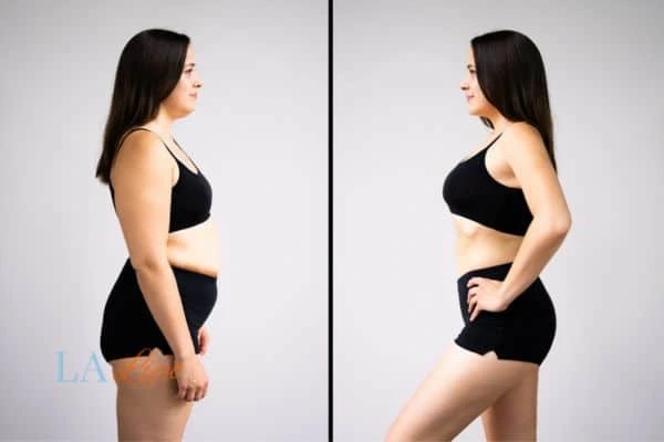 image of woman before and after results of LA-EMS Body Sculpting Bognor Regis to help treat Diastasis recti