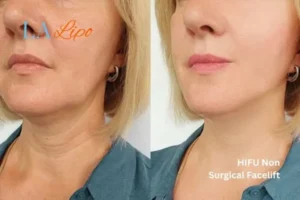 hi-fu for wrinkles Bognor Regis before and after results