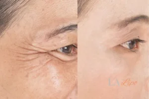 Before and after results of woman - HI-fu wrinkles reduction treatment Bognor Regis