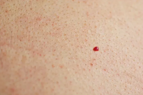 close up of a cherry angioma Bognor Regis