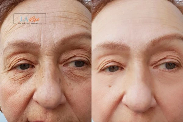 The powerful benefits of Morpheus8 Treatment Bognor Regis - Call Our team today!