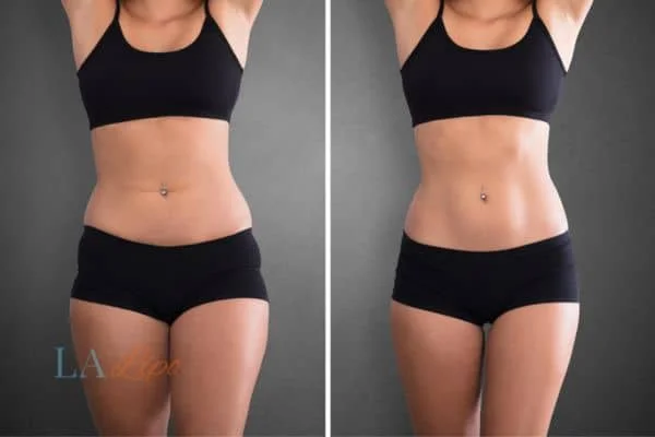 before and after results of non-surgical treatment to help a woman's body image and mental health Bognor Regis