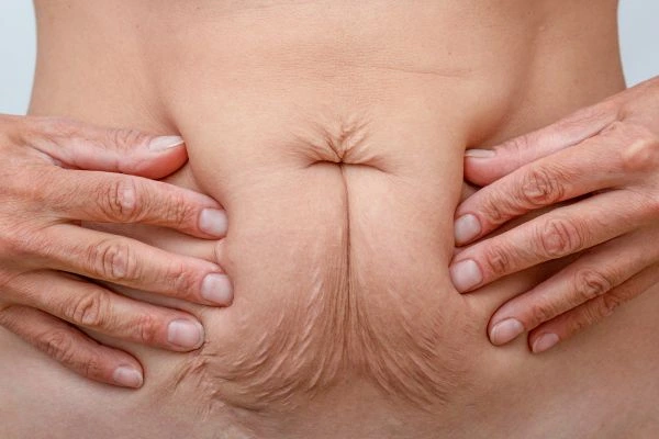 Should I Combine Diastasis Recti Treatment with Body Contouring for Better Results Bognor Regis?